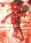 Remains of an aborted baby - abortion reality